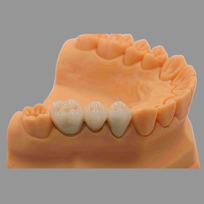 Buy Dental PFM Crown And Bridge Customizable With CoCr Ceramic Materials online manufacture