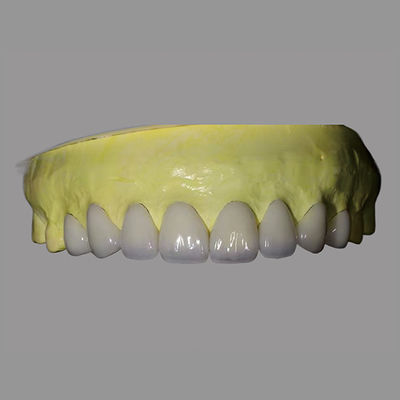 kopen Tandtechnisch laboratorium | Hoge doorschijnendheid IPS E Max fineer Vlekbestendig biocompatibel online manufacture