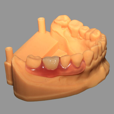 Buy Casting Valplast Dental Partials Unilateral Design Hypoallergenic online manufacture