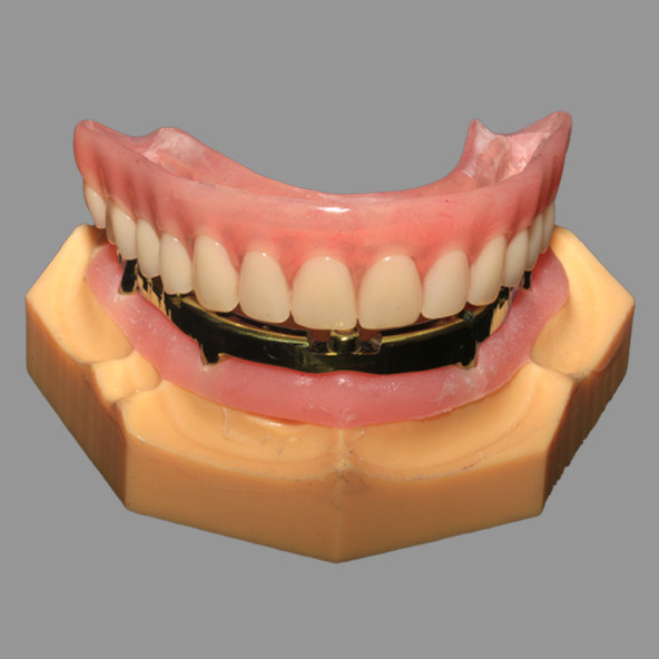 Full Acrylic Denture All-on-X Dental Implants AOX Class 4 With Locator Attachment